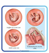 kronik otitis media cerrahileri kronik otitis media cerrahileri