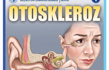 Otoskleroz 1