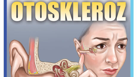Otoskleroz 1 Otoskleroz 1