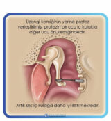 Otoskleroz 6 Otoskleroz 6