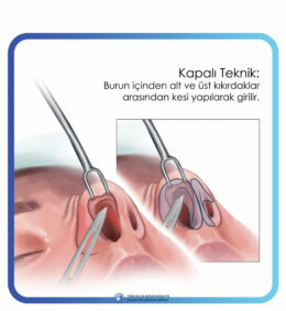 rinoplasti rinoplasti