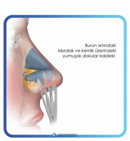rinoplasti rinoplasti