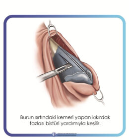rinoplasti rinoplasti
