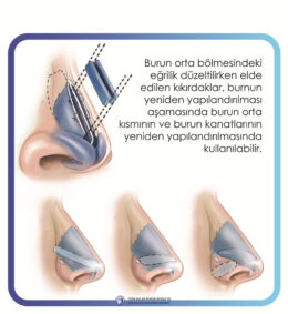 rinoplasti rinoplasti
