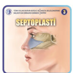 septoplasti