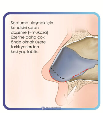 septoplasti septoplasti