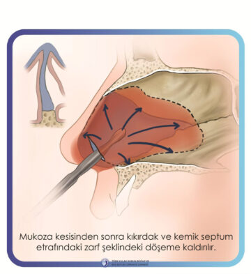 septoplasti septoplasti