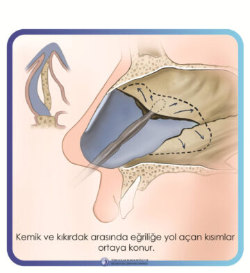 septoplasti septoplasti
