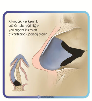septoplasti septoplasti