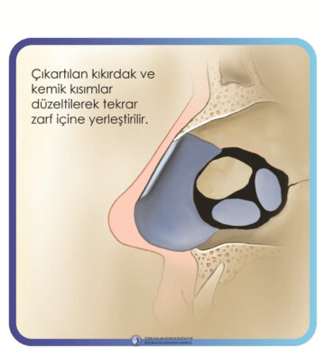 septoplasti septoplasti