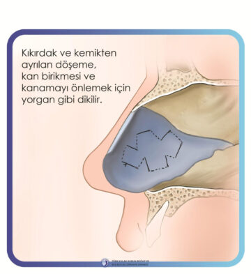 septoplasti septoplasti