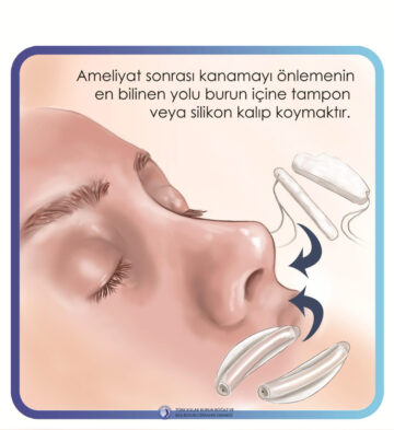 septoplasti septoplasti